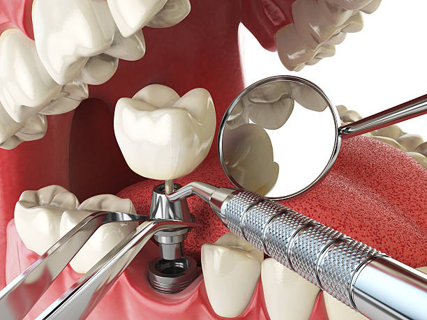 Best Emergency Treatment for Dental Infections or Abscesses in Bloomfield, NM